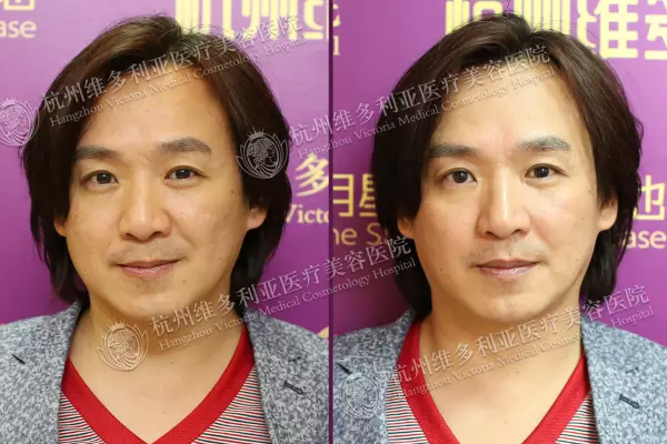 杭州维多利亚“古惑仔”蜂巢皮秒